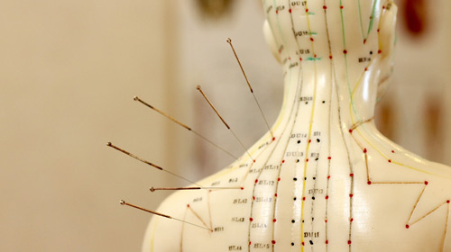 Acupuncture & Fibromyalgia